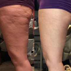 Hijama Pro™ 3 in 1 anti cellulite smart massager