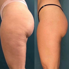 Hijama Pro™ 3 in 1 anti cellulite smart massager