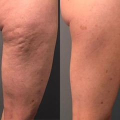 Hijama Pro™ 3 in 1 anti cellulite smart massager